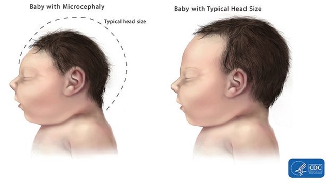 microcephaly-comparison pic_1453148243419_436989_ver1.0_640_360